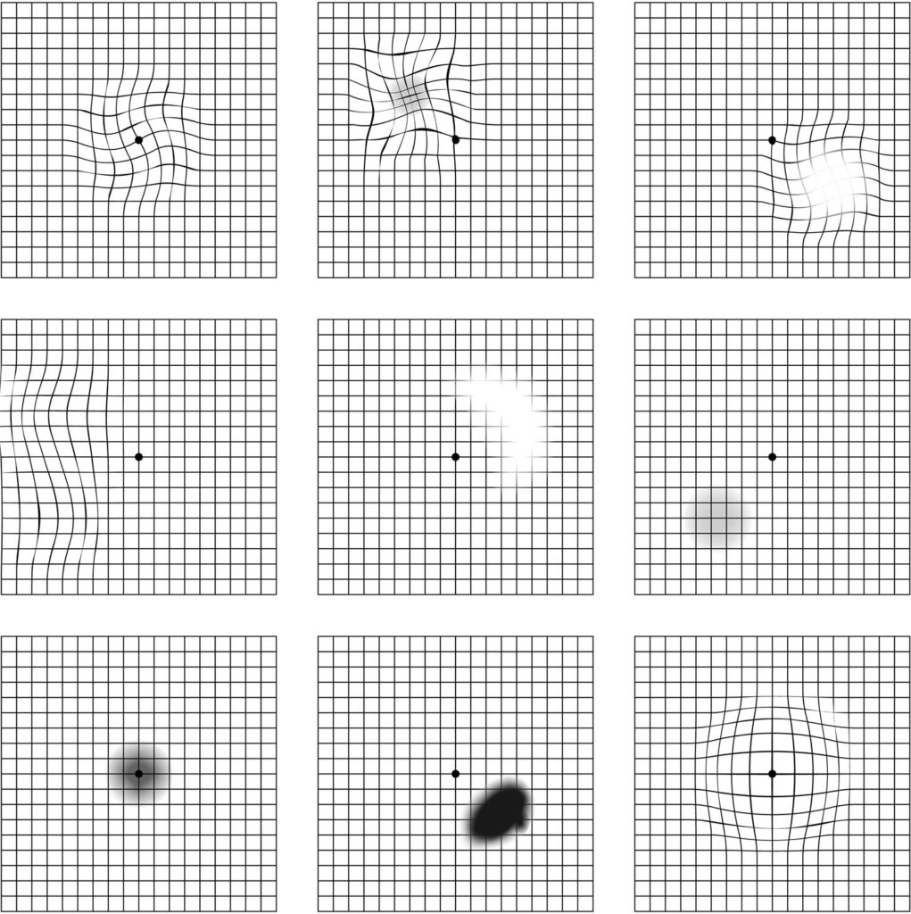 Grid Chart For Macular Degeneration Printable Worksheets