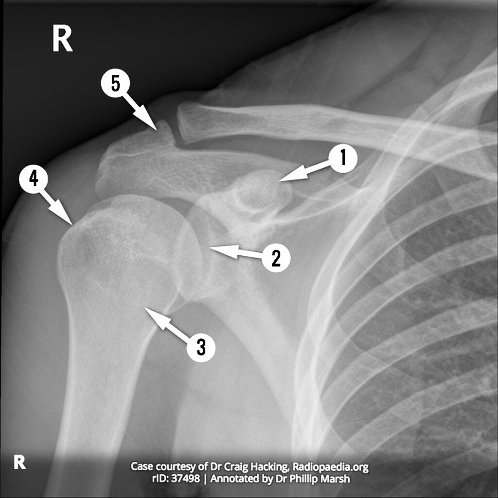 Shoulder Radiograph AP anatomy Quiz Radiology Case Radiopaedia