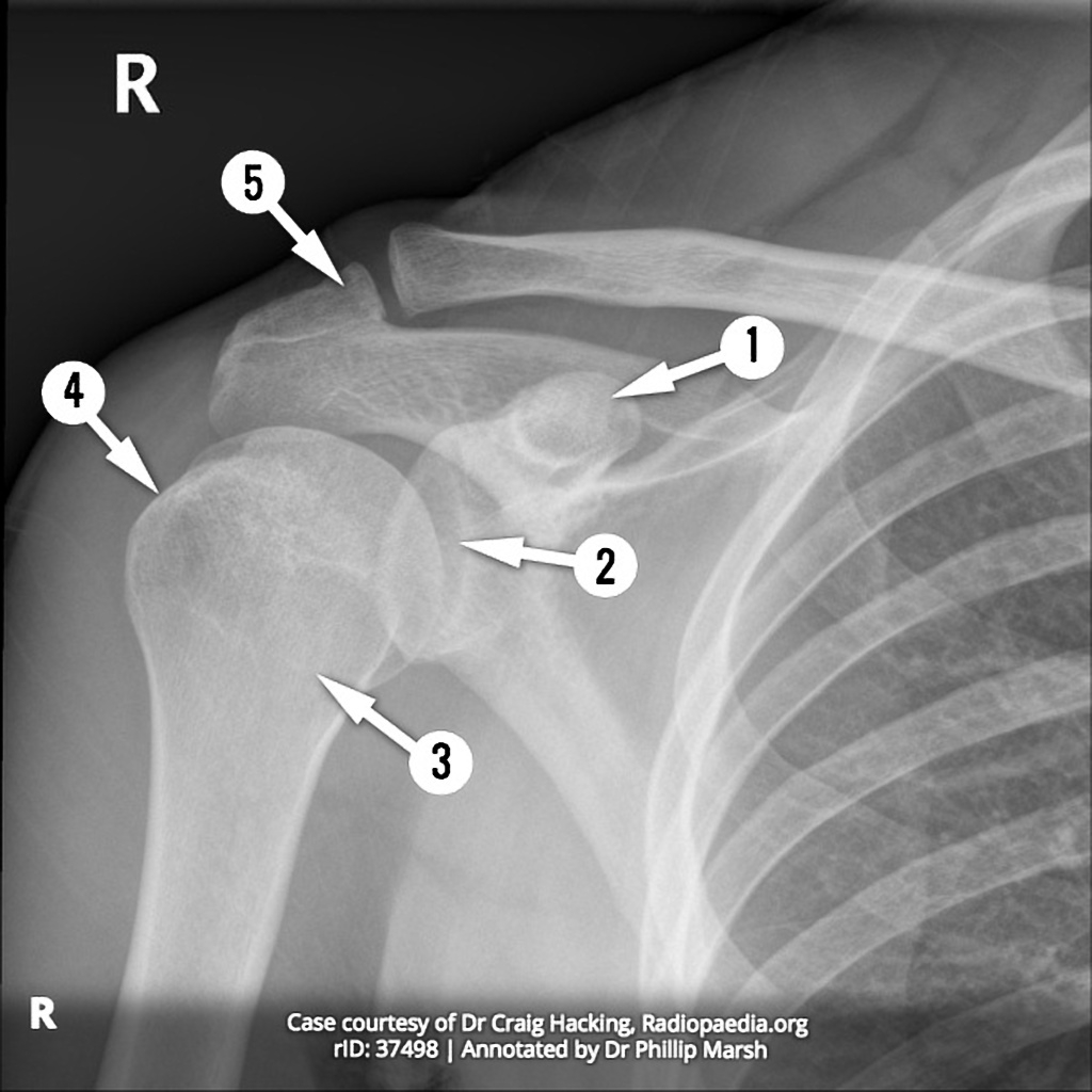 Shoulder Radiograph AP anatomy Quiz Radiology Case Radiopaedia